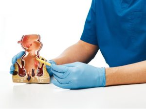 علاج البواسير : الأعراض والأسباب وطرق العلاج المثلى